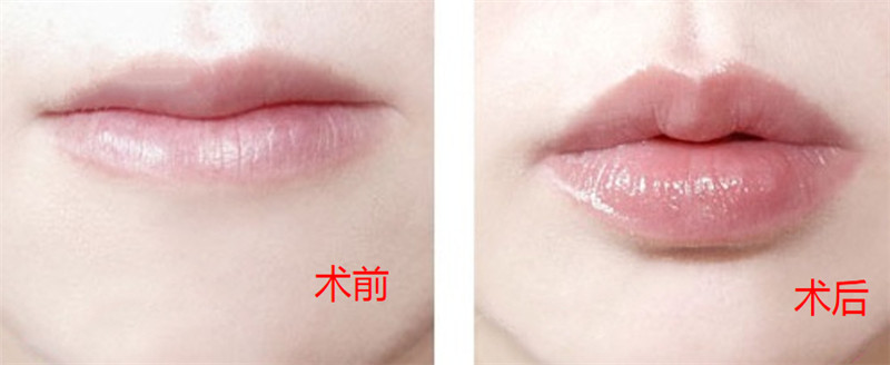 丰唇（注射）案例