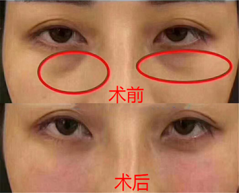 泪沟填充案例